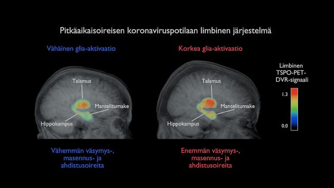 Oikeanpuoleinen aivojen TSPO-PET-kuva näyttää kohonnutta glia-aktivaatiota talamuksessa, mantelitumakkeessa ja hippokampuksessa long-covid potilaalla, jolla voimakkaat uupumus-, ahdistus- ja masennusoireet ovat jatkuneet pitkään SARS-CoV-2-infektion jälkeen. Vasemmalla vastaava kuva tilanteessa, jossa oireet ovat lievemmät. 

